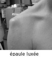 épaule luxée1