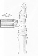 ostéotomie P1 - 21