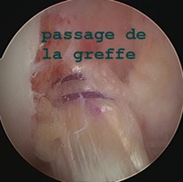 passage greffe 1